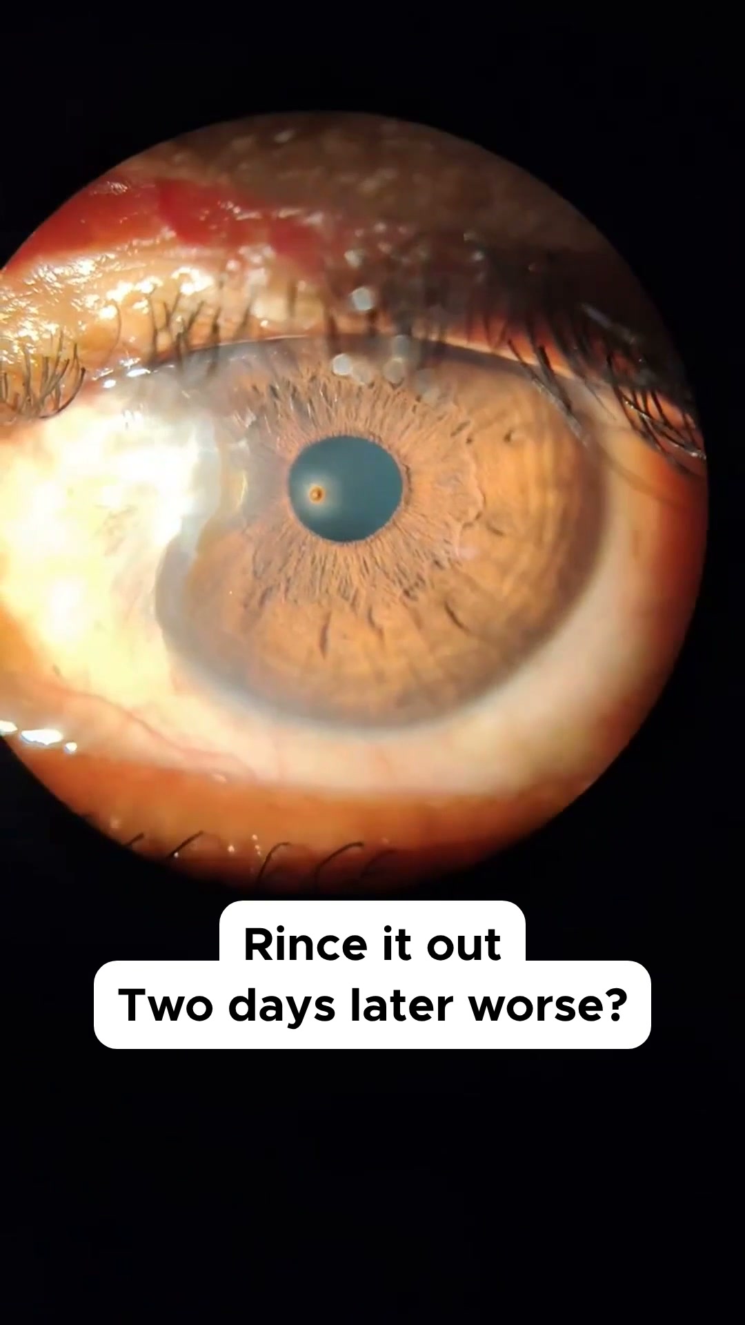 Something in the eye: foreign body case